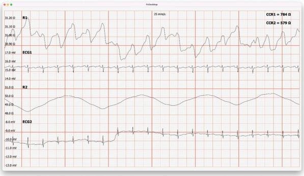 This physiological monitoring recording displays a four-channel data set captured via a transthoracic impedance system at a recording speed of 25 mm/s. The image illustrates a simultaneous recording of hemodynamics and respiratory patterns in a human subject. Channel R1 represents the base impedance measured in Ohms (Ω), oscillating between 30.9 and 31.2 Ω, reflecting transthoracic impedance changes related to cardiac cycle stroke volume. Synchronized with this is the ECG1 channel (millivolts, mV), showing standard QRS complexes and T waves used to correlate cardiac electrical activity with physical mechanical output. Channel R2 displays the impedance-derived breathing pattern, characterized by lower-frequency, smooth sinusoidal waves (48.0–51.0 Ω) that represent inhalation and exhalation cycles. ECG2 provides a secondary electrocardiographic lead for comprehensive rhythm analysis. This multi-modal visualization is characteristic of rheocardiographic examinations, used to calculate stroke volume and cardiac output by measuring the resistance of tissues to high-frequency alternating current. Such measurements are essential for evaluating cardiovascular and respiratory performance, particularly during or after physical activity.