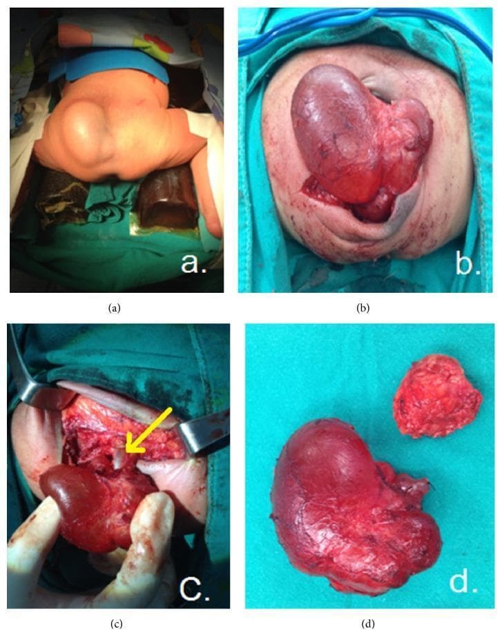A series of four clinical and surgical photographs (a-d) documenting the resection of a type I sacrococcygeal teratoma in a pediatric patient. (a) Pre-surgical view of the patient in a prone, frog-legged position, showing a large, skin-covered mass protruding from the sacrococcygeal region. (b) Intraoperative view demonstrating the mobilization of the tumor through a surgical incision; the mass is reddish-brown and lobulated. (c) Continued dissection showing the exposure of the deep attachments; a yellow arrow points to the coccyx being isolated for en bloc resection. (d) Post-excision specimen photograph showing the completely removed solid tumor and the attached coccyx on a surgical drape. This sequence illustrates the standard surgical technique of total tumor resection with coccygectomy to prevent recurrence in germ cell tumors. The pathology is characteristic of an extragonadal germ cell tumor in the neonatal or infant period, where complete excision is the primary treatment modality.
