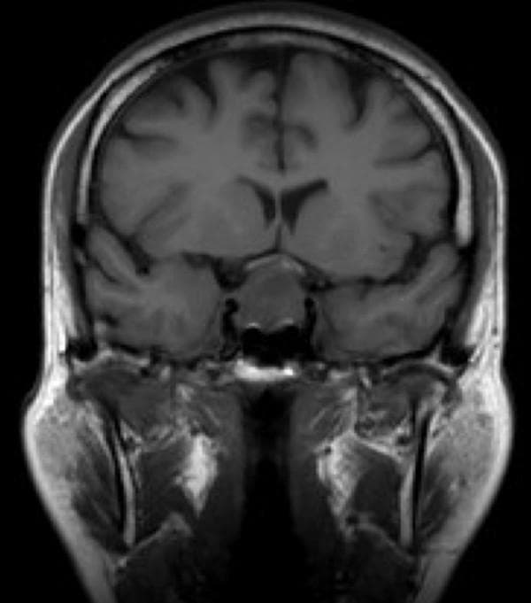 This diagnostic image is a coronal T1-weighted MRI scan of the brain, focused on the sellar and suprasellar regions. A prominent mixed solid and cystic mass is visible within an expanded sella turcica, consistent with a pituitary macroadenoma. The lesion measures approximately 20 x 16 mm and demonstrates superior extension. Crucially, the mass is shown bowing and indenting the optic chiasm, which provides a clinical explanation for visual field deficits such as bitemporal hemianopia. Anatomical landmarks including the frontal lobes, temporal lobes, and midline structures are visualized, alongside the facial soft tissues and bony structures of the skull base. The image serves as a classic educational example of how pituitary tumors can impact adjacent neuro-anatomical structures through mass effect, specifically illustrating the vulnerability of the optic chiasm to suprasellar extension of sellar masses.