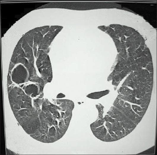 This diagnostic image is an axial computed tomography (CT) scan of the thorax, specifically focused on the lung parenchyma using a lung window setting. The image reveals bilateral pulmonary pathology characterized by multiple thin-walled, air-filled cavities. These cavities are variably sized, with a prominent cluster of large, well-defined circular and oval lucencies located in the right lung field. The surrounding parenchyma shows some evidence of increased interstitial markings and potential ground-glass opacities, which may indicate inflammation or hemorrhage. In the clinical context of pauci-immune crescentic glomerulonephritis and recurrent hemoptysis, these radiological findings are highly suggestive of pulmonary involvement in small-vessel vasculitis, such as Granulomatosis with Polyangiitis (GPA). The image demonstrates the hallmark features of cavitary lung disease, serving as a critical teaching tool for medical students and clinicians specializing in pulmonology, nephrology, and radiology to recognize the thoracic manifestations of systemic vasculitides and their potential for life-threatening complications like massive pulmonary hemorrhage.