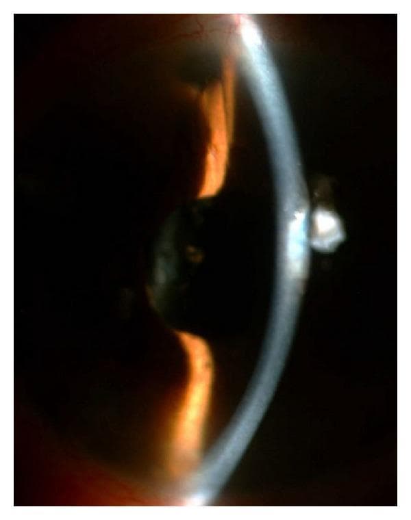 This slit-lamp clinical photograph of a right eye demonstrates the postoperative status following a surgical procedure to address malignant glaucoma. A narrow slit beam highlights the anterior segment anatomy, showing a deep anterior chamber, which contrasts with the shallow configuration typical of aqueous misdirection syndrome. Key surgical findings include a patent peripheral iridectomy located in the superior quadrant. More centrally, there is evidence of a capsulo-hyaloidectomy, where both the posterior lens capsule and the anterior hyaloid face have been surgically opened to facilitate aqueous flow. The slit-lamp section through the cornea shows clear tissue, though clinical context suggests previous corneal incisions secured with nylon sutures. This image serves as an educational example of successful surgical management for pupillary and ciliary block by creating a direct communication between the vitreous cavity and the anterior chamber.