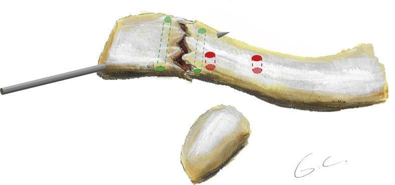 An anatomical diagram illustrating the surgical reduction and fixation planning for a distal clavicle fracture, likely a Neer Type II injury. The illustration depicts the distal third of the clavicle with a transverse fracture line. A metallic Kirschner wire (K-wire) is shown inserted laterally through the distal fragment into the proximal bone to maintain temporary reduction. The diagram highlights two distinct sets of surgical drill tunnels for definitive fixation: 1) Two green tunnels (2 mm diameter) oriented horizontally/anteroposteriorly across the fracture site, intended for figure-of-8 and figure-of-0 fracture cerclage using suture tape. 2) Two red tunnels (3.2 mm diameter) oriented vertically on the medial side of the fracture, intended for coracoclavicular cerclage using high-strength sutures. The placement of the medial tunnels reflects the anatomical insertion points of the coracoclavicular ligaments. This surgical strategy combines direct fracture site stabilization with stabilization of the coracoclavicular interval, addressing both bone and ligamentous components of the injury.