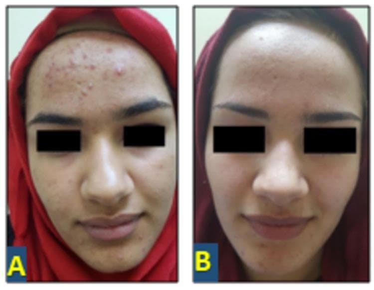 This clinical photograph exhibits a side-by-side comparison of a 17-year-old female with moderate acne vulgaris before and after treatment. Image A (baseline) demonstrates a high density of inflammatory and non-inflammatory lesions primarily concentrated on the forehead, with additional involvement of the cheeks and chin. Visible lesions include erythematous papules, pustules, and numerous closed and open comedones, set against a background of uneven skin texture and localized inflammation. Image B shows the same patient 12 weeks following the initiation of 2% topical spironolactone solution. This post-treatment image reveals a significant clinical improvement, characterized by a marked reduction in the total lesion count. The forehead appears notably smoother with a substantial clearance of papules and pustules. The overall skin tone is more uniform, and there is a visible decrease in inflammatory erythema, demonstrating the therapeutic efficacy of topical anti-androgen therapy in managing acne vulgaris and improving overall skin texture.