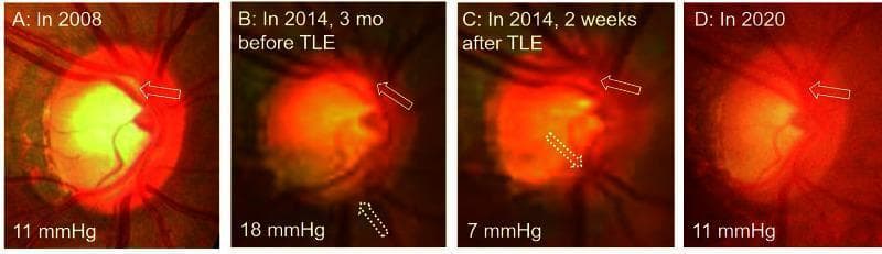 A series of four clinical fundus photographs (A-D) documenting optic disc morphological changes in a glaucoma patient over a 12-year period (2008–2020). The images illustrate the dynamic relationship between intraocular pressure (IOP) and optic nerve cupping. Panel A (2008) shows an oval optic disc with an IOP of 11 mmHg and a vertical cup-to-disc (C/D) ratio of 0.72. Panel B (2014) displays disease progression prior to trabeculectomy (TLE), characterized by an increased IOP (18 mmHg), thinning of the superior and inferior neuroretinal rims, a circular disc shape (H/V ratio = 1.0), and enlarged cupping (C/D ratio = 0.78). Panel C (two weeks post-TLE) demonstrates rapid structural reversal after IOP reduction to 7 mmHg, showing decreased cupping (C/D = 0.61) and centripetal shifting of the retinal vasculature. Panel D (2020) shows long-term stabilization at 11 mmHg, where the disc has largely regained its baseline oval morphology and rim area. This sequence serves as a clinical example of 'cup reversal' or optic disc remodeling following surgical intraocular pressure reduction.