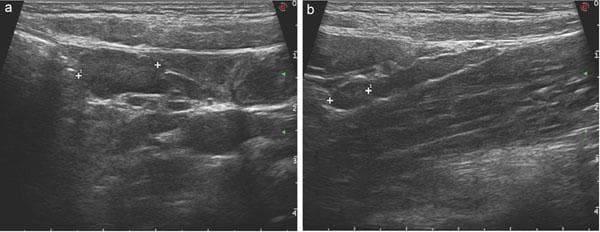 Two grayscale ultrasound images (labeled 'a' and 'b') of the abdominal cavity demonstrating findings consistent with mesenteric adenitis (adenomesenteritis), a common cause of acute abdomen in pediatric patients. In view 'a', multiple enlarged, hypoechoic lymph nodes are visible within the mesentery. These nodes are clustered and exhibit a characteristic chain-like arrangement, showing well-defined rounded to oval shapes with loss of the normal fatty hilum. View 'b' provides a detailed view of a specific enlarged mesenteric lymph node, delineated by caliper markers for measurement. The surrounding mesenteric fat appears slightly hyperechoic (inflamed). The imaging modality highlights the lack of radiation exposure, making it the preferred diagnostic tool for differentiating mesenteric lymphadenopathy from acute appendicitis in children. Key features illustrated include lymph node morphology, size, and spatial distribution along mesenteric vessels.