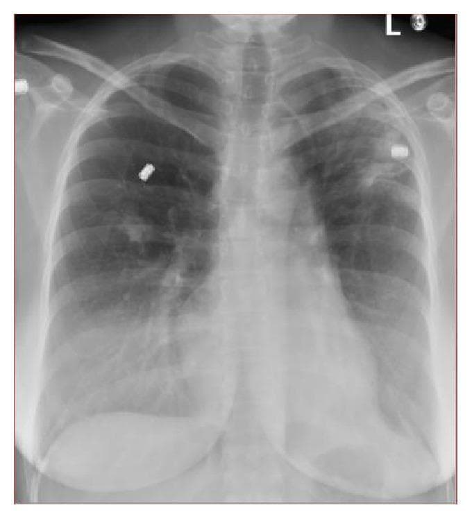 A posterior-anterior (PA) chest x-ray demonstrating bilateral pulmonary abnormalities. In the left upper lobe, there is a prominent hazy increased density or opacity, containing internal lucency suggestive of cavitary changes. The right lung shows a smaller, irregular density localized in the right middle lobe. These findings are clinically significant as they often represent infectious processes such as pulmonary tuberculosis or pyogenic pneumonia, or chronic fibrotic changes. The mediastinal contour and cardiothoracic ratio appear within normal limits. Radiopaque external markers are visible overlying the upper lung fields. This diagnostic image illustrates key radiological signs of pulmonary infiltration and cavitation, relevant for medical education regarding the diagnostic workup of mycobacterial infections and differential diagnosis of apical lung lesions.