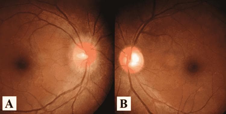 This dual-panel fundus photograph provides a side-by-side comparison of different optic nerve head pathologies in the right and left eyes. Panel A depicts the right eye fundus, showing a markedly hyperemic and swollen optic disc. The disc margins are blurred and indistinct, indicating significant edema, with an absence of a visible physiologic cup. The surrounding retinal vasculature appears slightly engorged. Panel B shows the left eye fundus, characterized by prominent temporal pallor of the optic disc. Unlike the right eye, the disc in the left eye is not elevated, and the nasal margin appears relatively more defined, though the temporal aspect exhibits a stark white coloration indicative of optic atrophy. Both panels show the macula temporally positioned relative to the disc. This comparison is clinically relevant for neuro-ophthalmological evaluation, potentially illustrating conditions such as Foster Kennedy syndrome (though intracranial pressure and imaging context are required for definitive diagnosis) or sequential optic neuropathy involving acute swelling in one eye and chronic atrophy in the other.