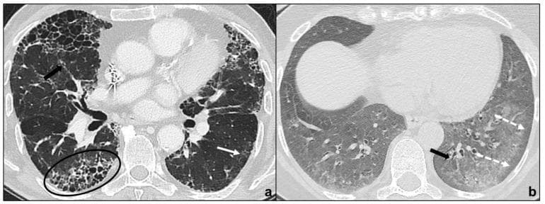 This diagnostic image consists of two high-resolution computed tomography (HRCT) axial scans of the chest demonstrating chronic fibrosing idiopathic interstitial pneumonias (IIPs). Panel (a) illustrates a Usual Interstitial Pneumonia (UIP) pattern, characterized by significant architectural distortion, irregular reticular opacities, and prominent macrocystic honeycombing in the basal and subpleural regions (indicated by a black oval). Traction bronchiectasis is visible (black arrow), along with limited, non-prevalent ground-glass opacities (white arrow). Panel (b) illustrates a Non-Specific Interstitial Pneumonia (NSIP) pattern. This is characterized by bilateral, diffuse, and basal ground-glass opacities. A key diagnostic feature shown is the relative sparing of the subpleural pulmonary parenchyma (indicated by white dotted arrows). Additional findings in panel (b) include irregular reticular opacities and traction bronchiectasis (black arrow). These images serve as a comparative educational resource for identifying radiological hallmarks that differentiate IPF/UIP from NSIP, focusing on the distribution of fibrosis, the presence of honeycombing, and subpleural sparing.