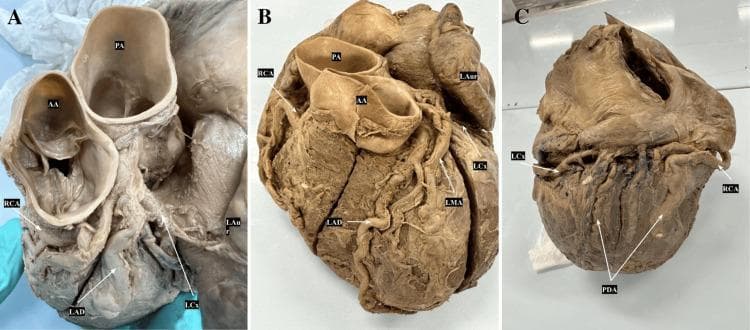 This set of three clinical photographs (A, B, and C) displays a dissected human heart specimen to illustrate coronary artery anatomy and branching patterns. Image A provides an anterosuperior view, highlighting the origins of the Right Coronary Artery (RCA) from the right aortic sinus and the Left Anterior Descending (LAD) and Left Circumflex (LCx) arteries near the Ascending Aorta (AA) and Pulmonary Artery (PA). Image B shows an anterior view of the heart, detailing the LAD descending in the anterior interventricular groove, the LCx wrapping around the left auricle (LAur), and the Left Marginal Artery (LMA) branching from the LCx. Image C presents a posterior view demonstrating a codominant coronary system. In this specimen, the Posterior Descending Artery (PDA) is formed by contributions from both the terminal branches of the RCA and the LCx as they meet at the crux of the heart. These images serve as educational material for cardiovascular anatomy, specifically focusing on variations in coronary dominance and the structural relationship between major epicardial vessels.