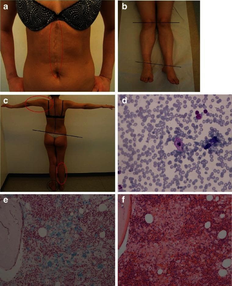 A multi-panel figure illustrating clinical and pathological findings associated with Gaucher disease (GD). Panel a is a clinical photograph of a patient's abdomen showing a large, midline vertical surgical scar (post-splenectomy). Panels b and c show clinical musculoskeletal photographs with annotations highlighting skeletal deformities; red circles indicate primary malformations of the right leg and left arm, while black lines and circles denote secondary postural changes in the spine and feet. Panel d is a bone marrow cytology slide (May-Grünwald Giemsa stain) showing a centrally located histiocyte with classic 'crinkled paper' Gaucher cell morphology. Panels e and f present bone marrow histology sections stained with iron-hematoxylin (e) and hematoxylin and eosin (f), respectively, demonstrating extensive histiocytic infiltration composed of pale-staining Gaucher cells among marrow elements. This visual summary correlates the gross clinical manifestations of lysosomal storage disorders, such as massive organomegaly and skeletal complications, with microscopic cellular evidence of substrate accumulation.