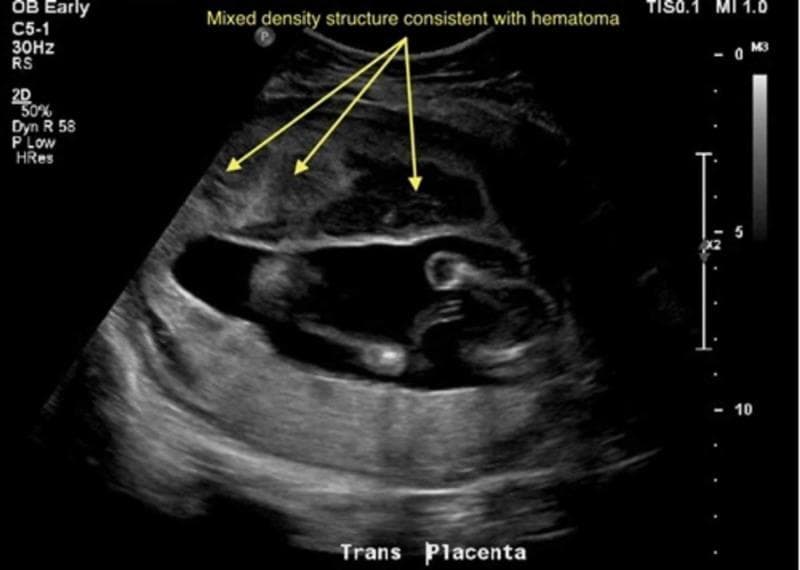 This obstetric diagnostic ultrasound image, oriented in a transverse plane ('Trans Placenta'), illustrates a significant pathology following trauma. The primary finding is a large, anteriorly located heterogeneous mass measuring approximately 12.0 x 5.4 x 9.5 cm. This mixed-density structure exhibits irregular echotexture, characterized by interspersed hypoechoic (darker) and echogenic (brighter) areas, indicated by yellow arrows and labeled as consistent with a hematoma. Below this collection, the amniotic cavity is visible, containing fetal structures and anecdotal evidence of amniotic fluid. In the lower (posterior) segment of the uterus, the placenta is visualized. The visual characteristics of the anterior heterogeneous mass, particularly its location relative to the placental site and its internal echoes, are highly suggestive of placental abruption with a retroplacental or preplacental hematoma. This image serves as a clinical teaching tool for evaluating obstetric trauma and identifying signs of acute placental separation and internal uterine hemorrhage in an emergency setting.