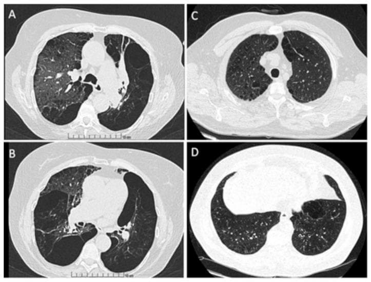 This diagnostic comparison presents four axial High-Resolution Computed Tomography (HRCT) lung windows, categorized by smoking history and anatomical level. Images A and B display the upper and lower lobes of an active smoker with the M/MProcida genotype. These images demonstrate significant structural lung damage, including centrilobular and paraseptal emphysema characterized by areas of low attenuation, architectural distortion, and bronchial wall thickening suggestive of bronchiectasis. Large bullae are particularly visible in the lower lobe periphery (Image B). In contrast, Images C and D display the upper and lower lobes of a never smoker with the M/I genotype. These scans show relatively preserved lung parenchyma with homogenous density and normal pulmonary vascular distribution, though minor areas of ground-glass opacity are present. The comparison highlights the severity of obstructive lung disease manifestations, specifically the progression of emphysematous changes and airway remodeling associated with chronic tobacco exposure in the context of Alpha-1 Antitrypsin Deficiency genetic variants. This material is suitable for medical education regarding radiology of Chronic Obstructive Pulmonary Disease (COPD).