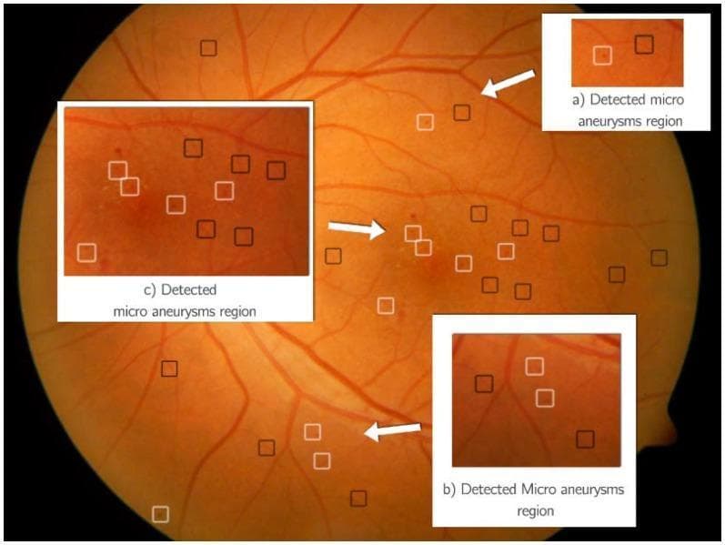 This diagnostic clinical photograph shows a processed color fundus image of a human retina, highlighting automated detection of diabetic retinopathy signs. The fundus background displays a standard brownish-orange hue with visible anatomical structures, including branching retinal vasculature and the optic disc margin. The image is annotated with bounding boxes from an automated classification system designed to identify microaneurysms (MAs). White boxes indicate regions positively identified as microaneurysms, which appear as subtle, dark red, dot-like lesions often located near fine vascular branches. Black boxes indicate candidate regions classified as 'Not MA,' representing background noise, small vessel segments, or other non-pathological features. Three inset magnifications (labeled a, b, and c) provide detailed views of these detections, illustrating the morphological similarities between true microaneurysms and anatomical background elements. This visual is used to demonstrate the performance of Hidden Markov Models (HMM) and ensemble classifiers in differentiating clinical signs of diabetic retinopathy from normal retinal features.
