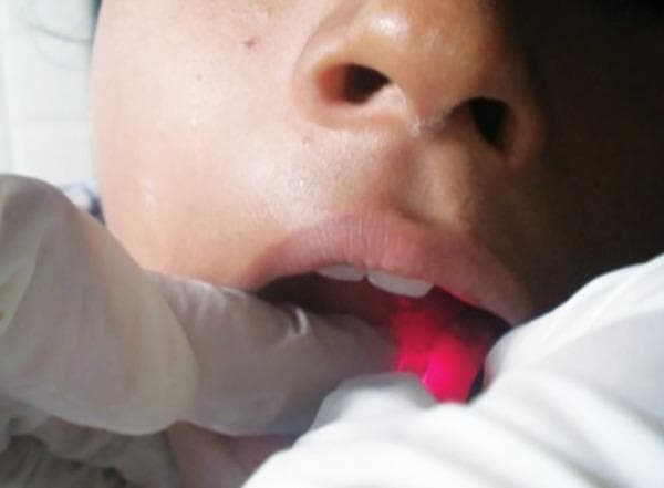 This clinical photograph demonstrates a procedural setup for dental pulse oximetry, a non-invasive method used to assess dental pulp vitality. The image shows a close-up of a patient's mouth with a gloved operator positioning a modified pulse oximeter probe (Nellcor OxiMax style) against a maxillary tooth. A distinctive red light emission is visible from the probe, which is being held against the buccal surface of the clinical crown. This technique measures oxygen saturation (SpO2) within the pulpal microcirculation to determine tissue health, providing an objective alternative to traditional thermal or electric pulp testing. The surrounding perioral skin and lips appear healthy, and the procedure is being performed in a controlled clinical environment, likely within pedodontics or endodontics. The educational focus is on the clinical application of pulse oximetry in dentistry for vitality assessment.