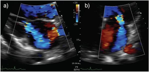 Transthoracic echocardiographic images with color Doppler demonstrating acute on chronic mitral regurgitation (MR). Figure A shows a parasternal long-axis (PLAX) view during systole, highlighting a large, posteriorly directed regurgitant jet originating at the coaptation point of the mitral valve and extending into the left atrium. Figure B displays an apical four-chamber (A4C) view of the same jet. The color Doppler signal is characterized by a mosaic pattern of blue, red, and yellow, indicating high-velocity turbulent flow and significant aliasing. The jet is eccentric, suggesting a specific valvular mechanism such as ischemic tethering of the posterior mitral valve leaflet (PMVL). In both views, the regurgitant volume occupies a significant portion of the left atrial area, supporting the diagnosis of severe mitral regurgitation. The Doppler scale is set at +/- 56 cm/s, and a simultaneous ECG strip at the bottom indicates a heart rate of 79 BPM. This visual is used to teach the identification of jet direction, turbulence, and spatial orientation in secondary mitral valve disease.