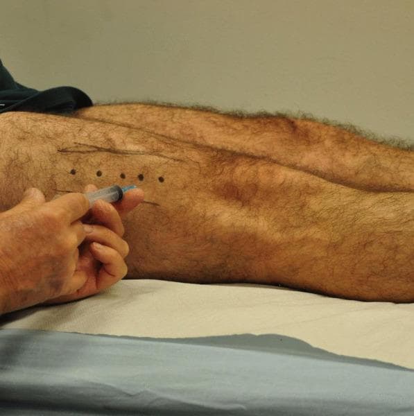 This clinical photograph demonstrates the procedural administration of Botulinum Toxin Type A (BoNT-A) into the vastus lateralis muscle of a patient's lower extremity. The patient is positioned supine, with the lateral aspect of the thigh exposed. Anatomical marking is evident on the skin, featuring five discrete, linearly arranged dark dots spaced at approximately 3 cm intervals, serving as specific injection site targets. These marks are positioned 3–5 cm proximal to the patella on an oblique angle lateral to the midline. A healthcare provider's hand is visible holding a standard medical syringe with a fine-gauge needle, positioned to perform an intramuscular injection at one of the marked sites. The educational focus is on the standardized clinical protocol for treating musculoskeletal conditions, such as patellofemoral pain syndrome or muscle imbalances, through targeted chemodenervation. The image highlights the importance of precise surface anatomy mapping for outpatient office-based procedures performed without continuous image guidance.