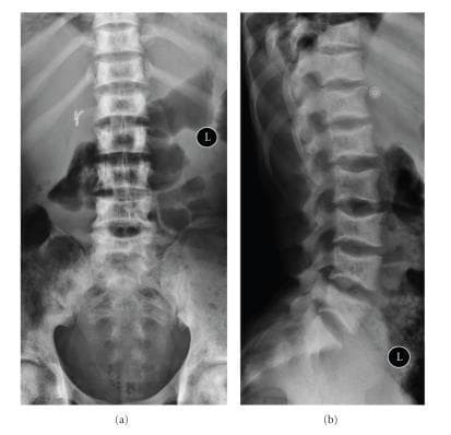 This diagnostic image displays two plain radiographs of the lumbar spine: an anteroposterior (AP) view (a) and a lateral view (b). The radiographs demonstrate classic skeletal manifestations of sickle cell disease. Image (a) shows 'H-shaped vertebrae' characterized by sharp, step-like depressions in the central portion of the vertebral endplates, secondary to microvascular end-plate infarction (Reynold's sign). Image (b) illustrates 'fish mouth vertebrae,' showing smooth, biconcave depressions of the endplates caused by bone softening and chronic osteopenia. Beyond the spine, the AP view reveals patchy sclerosis of the pelvic bones, suggesting chronic medullary bone infarction, and radiopaque cholecystectomy clips in the right upper quadrant, indicating prior surgical removal of the gallbladder for pigment stones. The images provide high-yield educational examples of musculoskeletal complications in sickle cell anemia, including avascular necrosis of the vertebral endplates and changes in bone density.