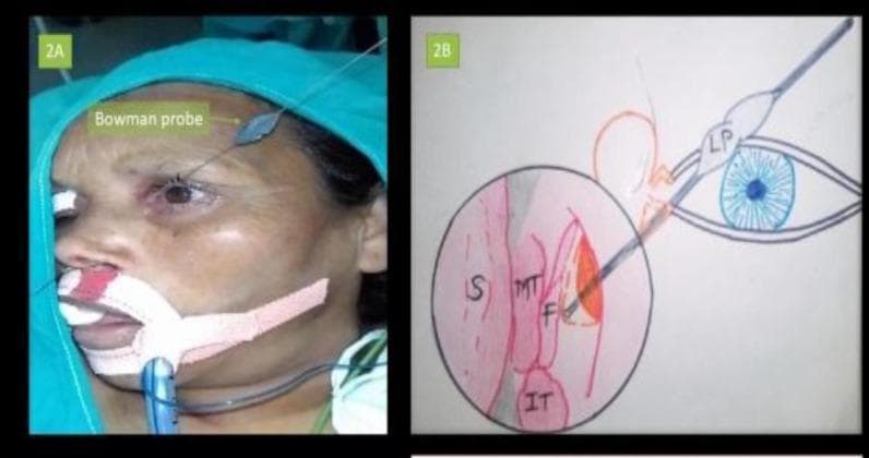 A multi-panel image illustrating the Bowman’s technique for lacrimal probing during endonasal dacryocystorhinostomy (DCR). Panel 2A is a clinical procedural photograph of a patient under general anesthesia, prepped with surgical drapes and an endotracheal tube. A Bowman lacrimal probe is visible, inserted through the superior punctum of the left eye to navigate the lacrimal drainage system. Panel 2B is a corresponding anatomical diagram and endoscopic view illustration. It depicts the lacrimal probe (LP) passing through the canalicular system and emerging into the nasal cavity. Key endonasal landmarks are labeled: Nasal Septum (S), Middle Turbinate (MT), Inferior Turbinate (IT), and the surgically created Mucosal Flap (F). This visual aids in understanding the spatial relationship between external ophthalmic structures and endonasal anatomy during surgical management of nasolacrimal duct obstruction. The content is designed for intermediate to advanced medical education in ophthalmology and otolaryngology.