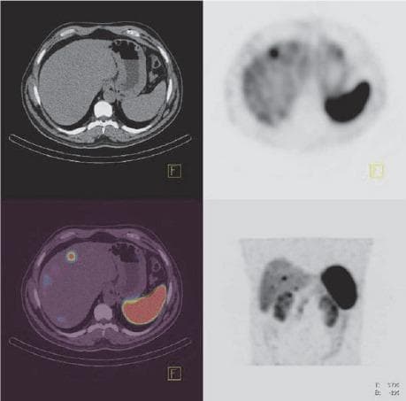 This composite diagnostic image displays a multi-modal radiological assessment of the abdomen using SPECT, CT, and fused SPECT/CT imaging. The top-left panel is a transaxial CT scan showing abdominal anatomy, including the liver, spleen, and stomach; a subtle hypoattenuating lesion is visible in the liver parenchyma. The top-right and bottom-right panels show transaxial and coronal SPECT images, respectively, utilizing 99mTc-Hynic TOC to detect somatostatin receptor-positive tissues. These functional images reveal intense radiotracer uptake (hot spots) in the spleen (physiological) and localized pathological uptake in the duodenum and multiple liver lesions. The bottom-left panel demonstrates a fused transaxial SPECT/CT, precisely localizing the radiopharmaceutical activity to the anatomical lesions identified on CT. This imaging series is characteristic of a gastroenteropancreatic neuroendocrine tumor (NET) evaluation, highlighting both the primary tumor in the duodenum and secondary metastatic spread to the liver. The study illustrates the superior sensitivity of functional molecular imaging over conventional CT for staging metastatic disease in NET patients.