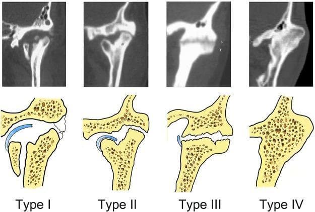 This educational composite image presents four distinct types of temporomandibular joint (TMJ) ankylosis, classified from Type I to Type IV. Each category features a coronal Computed Tomography (CT) scan image paired with a corresponding schematic illustration for visual clarity.
- Type I (Non-bony ankylosis): The CT and diagram show a relatively preserved joint space and identifiable articular disc, though with rough surfaces and potential fibrous adhesions.
- Type II (Lateral bony ankylosis): Visible bony fusion is restricted to the lateral aspect of the joint. The medial portion maintains a discernible joint space with a displaced condyle.
- Type III (Complete bony ankylosis): Demonstrates complete osseous fusion across the entire joint area. A horizontal radiolucent line is visible within the bony mass, representing residual joint remnants, though the anatomical condyle and fossa are no longer distinct.
- Type IV (Extensive bony ankylosis): Shows total obliteration of the joint by a massive, uniform bony block. There is a complete lack of a radiolucent line, signifying total synostosis.
This resource serves as a diagnostic guide for oral and maxillofacial surgeons to identify the severity of TMJ trauma sequelae.