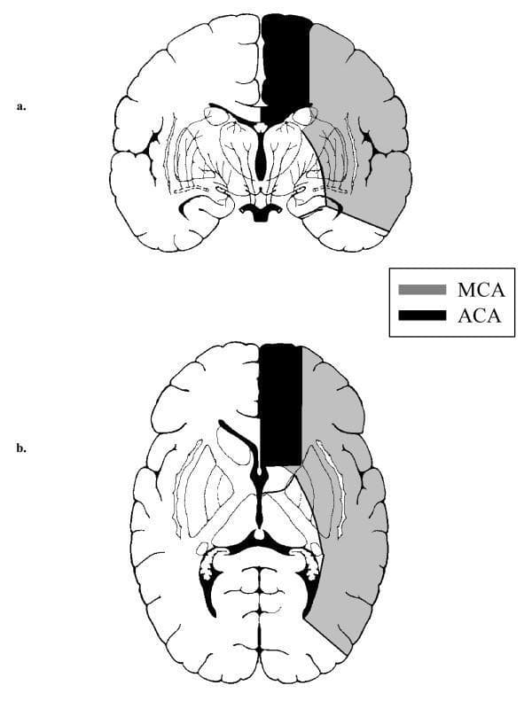 This medical illustration depicts the vascular territories of the cerebral arteries in the human brain across two anatomical planes: (a) a coronal section and (b) an axial section. The diagram utilizes a grayscale coding scheme to differentiate the arterial supply of the cerebral hemispheres. The anterior cerebral artery (ACA) territory is highlighted in black, primarily occupying the medial aspect of the frontal and parietal lobes, including the cingulate gyrus and the frontal pole. The middle cerebral artery (MCA) territory is shaded in gray, covering the expansive lateral surfaces of the frontal, parietal, and temporal lobes, as well as deep structures like the basal ganglia and internal capsule. The educational focus is on the spatial distribution and boundaries between these major vascular zones, which is critical for clinical localization in neurovascular conditions like ischemic stroke. The presence of anatomical landmarks such as the ventricles and subcortical nuclei provides context for the depth and extent of the arterial perfusion areas.