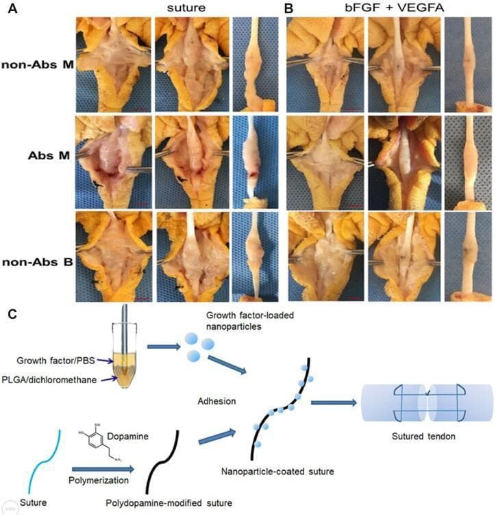 This composite educational image illustrates experimental methods for tendon repair and adhesion prevention. Panels A and B contain clinical photographs from an animal model (chicken flexor tendon) comparing surgical outcomes across three suture types: non-absorbable monofilament (non-Abs M), absorbable monofilament (Abs M), and non-absorbable braided (non-Abs B). Group A (Suture) shows control results with standard sutures, demonstrating significant peritendinous adhesions, disorganized tissue structure, and in the Abs M group, visible gaps and focal redness at the repair site. Group B (bFGF + VEGFA) shows tendons treated with nanoparticle-coated sutures loaded with basic fibroblast growth factor and vascular endothelial growth factor A. These specimens exhibit smoother surfaces, reduced scarring, and improved longitudinal tissue integration. Panel C is a pathophysiology and bioengineering diagram detailing the suture modification process: growth factors are encapsulated in PLGA nanoparticles and adhered to dopamine-polymerized sutures. The final schematic shows the modified suture applied to a transected tendon, aiming to facilitate organized healing and reduce post-operative adhesions.