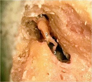 This clinical photograph provides a cadaveric dissection view of the middle ear cavity, illustrating the anatomical arrangement of the human ossicular chain. The image displays the three primary ossicles in their healthy, articulated positions. The head of the malleus (labeled 1) is shown in close physical contact with the body of the incus (labeled 2), forming a normal incudo-malleolar joint. Progressing medially and inferiorly, the long process of the incus (2) is seen in direct continuity with the head of the stapes (labeled 3) at the incudo-stapedial joint. The surrounding temporal bone has been partially dissected to expose the tympanic cavity, highlighting the relative spatial orientation of these structures. This image serves as a reference for normal anatomy in the assessment of post-traumatic ossicular luxation or middle ear pathology. It is intended for intermediate to advanced medical learners studying otolaryngology or temporal bone radiology.