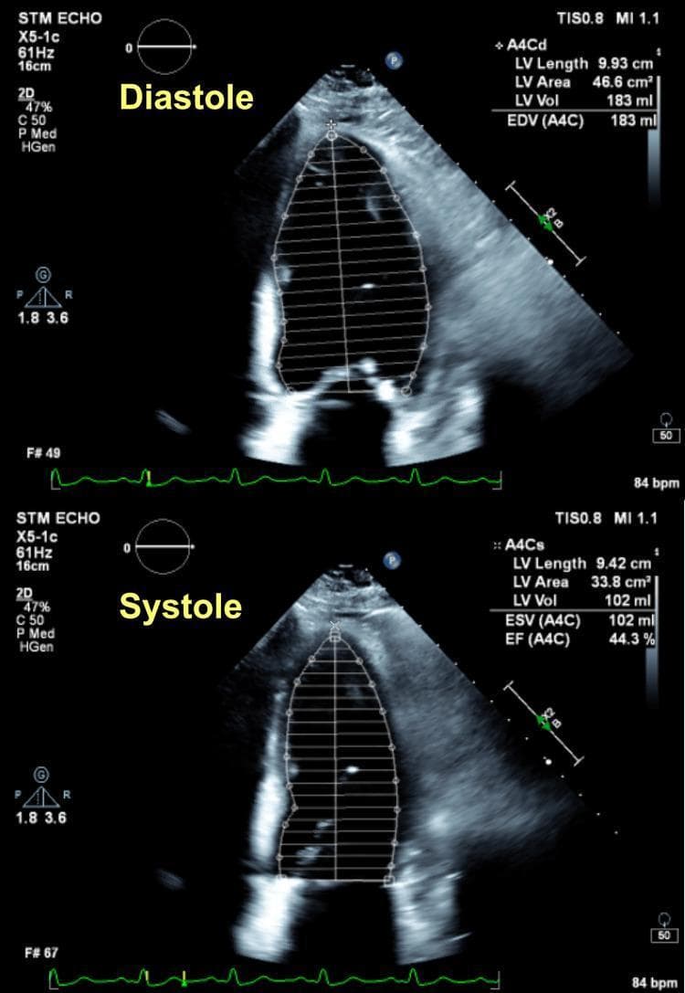 A comparison chart containing two panels of a transthoracic echocardiogram (TTE) in the apical four-chamber (A4C) view, illustrating the calculation of left ventricular ejection fraction (LVEF) using the Simpson's method of disks. The top panel, labeled 'Diastole', shows the end-diastolic phase with a segmented trace outlining the left ventricular cavity. Measurements displayed include an LV Length of 9.93 cm, LV Area of 46.6 cm², and an End-Diastolic Volume (EDV) of 183 ml. The bottom panel, labeled 'Systole', displays the end-systolic phase with a trace measuring an LV Length of 9.42 cm, LV Area of 33.8 cm², and an End-Systolic Volume (ESV) of 102 ml. Based on these volumetric measurements, a calculated Ejection Fraction (EF) of 44.3% is provided. An integrated electrocardiogram (ECG) strip at the bottom of each panel correlates the visual frames with the cardiac cycle. This diagnostic image demonstrates the assessment of systolic function in a patient with a history of coronary artery disease.