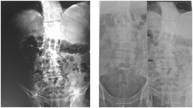 This diagnostic image set consists of conventional anteroposterior (AP) X-ray radiographs of the lumbar spine, pelvis, and abdomen. The left image demonstrates a marked increase in bone density (osteosclerosis) throughout the visualized axial skeleton, including the lumbar vertebrae and pelvic bones, resulting in a 'chalk-like' appearance where the trabecular patterns are obscured. The right set provides comparative views of the lumbar spine and pelvic brim. The prominent radiographic finding of diffuse sclerosis is a hallmark characteristic of skeletal fluorosis, particularly in the context of chronic high fluoride exposure. Visible anatomical structures include the lumbar vertebral bodies, transverse processes, sacroiliac joints, and the iliac crests. These images illustrate the skeletal manifestations of fluoride toxicity, which can lead to bone pain and increased fracture risk despite the apparent increase in density. The clinical relevance focuses on environmental health and metabolic bone diseases, emphasizing the use of radiography in identifying chronic fluoride intoxication.