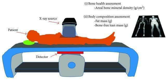 This medical illustration depicts a Dual-Energy X-ray Absorptiometry (DEXA) scanner setup and its clinical applications. The central diagram shows a patient in the supine position on a scanning table. Key instrumental components are identified: an X-ray source positioned above the patient and a detector located directly beneath the table, illustrating the transmission of X-ray beams through the body. Textual annotations outline the dual utility of the modality: (i) Bone health assessment, which measures areal bone mineral density (g/cm²), and (ii) Body composition assessment, which quantifies fat mass (g) and bone-free lean mass (g). To the right, representative diagnostic images from a DEXA scan are displayed, including a skeletal view and a soft tissue body composition map. This visual serves as an educational summary of how DEXA scans utilize high- and low-energy X-ray beams to accurately differentiate and measure various body tissues for metabolic and musculoskeletal health evaluations.