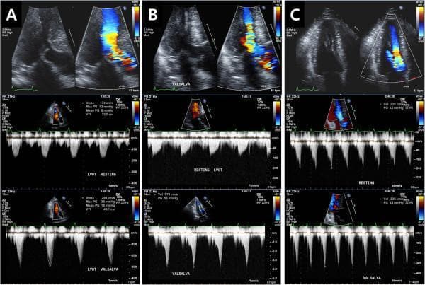 This composite diagnostic image displays three distinct cases (A, B, and C) of dynamic left ventricular outflow tract obstruction (DLVOTO) evaluated through echocardiography. Each column represents a clinical scenario and includes 2D grayscale, color flow Doppler, and continuous-wave (CW) spectral Doppler imaging at both rest and during a Valsalva maneuver. Row 1 shows apical views with color Doppler demonstrating turbulent, high-velocity jets (aliasing) in the LVOT. Row 2 and 3 provide CW Doppler spectral envelopes documenting peak velocity and pressure gradients (PG). Case A illustrates classic systolic anterior motion (SAM) of the mitral valve leaflets. Case B demonstrates chordal SAM, where the chordae tendineae move toward the septum. Case C shows DLVOTO caused by prominent papillary muscles 'kissing' the interventricular septum. Across all cases, the Valsalva maneuver typically increases the peak velocity and pressure gradient, as evidenced by the taller, late-peaking 'dagger-shaped' spectral envelopes in the bottom row. These findings are diagnostic of dynamic rather than fixed obstruction, common in conditions like hypertrophic cardiomyopathy (HCM) or sigmoid septum.