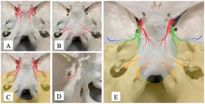 This medical anatomical diagram illustrates the arterial blood supply and vascular distribution patterns across the internal skull base, specifically focusing on feeders involved in skull base meningiomas. The composite image consists of five sub-figures (A-E) superimposed on a superior view of a human skull model. Sub-figure A depicts the Dorsal Meningeal Artery (DMA) in red, originating from the meningohypophyseal trunk and descending along the upper clivus. Sub-figure B shows the Ascending Pharyngeal Artery (APA) in orange, distributing around the foramen magnum and lower clivus. Sub-figure C highlights the Tentorial Artery (TA) in green, following the course of the tentorium cerebelli. Sub-figure D illustrates the Petrosal Branch (PB) in blue, arising from the middle meningeal artery near the foramen spinosum and reaching the petrous apex. Sub-figure E provides a summarized color-coded overlay demonstrating the spatial relationships of these four vascular territories relative to the clivus, petrous bone, and foramen magnum. This visual guide assists in identifying potential feeding arteries based on the tumor's dural attachment site during preoperative planning for meningioma resection.