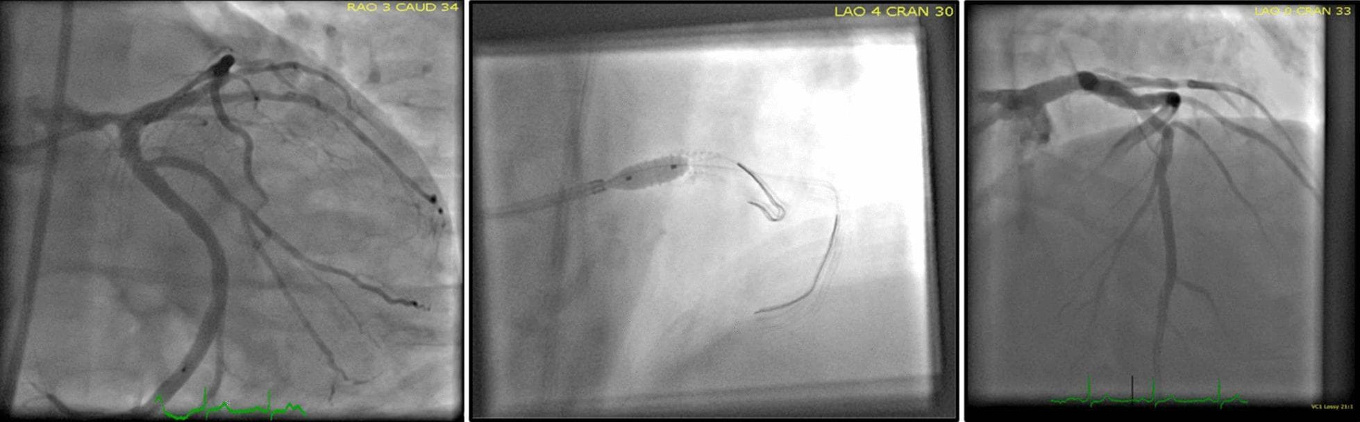 This composite of three diagnostic fluoroscopic images illustrates a percutaneous coronary intervention (PCI) procedure, specifically demonstrating Left Main (LM) coronary artery stenting using the kissing balloon technique. The left panel shows a coronary angiogram in an RAO Caudal projection (spider view), providing clear visualization of the distal left main bifurcation into the left anterior descending (LAD) and circumflex (LCx) arteries with contrast enhancement. The central panel captures the interventional phase in an LAO Cranial projection, showing a catheter-delivered angioplasty balloon inflated at the bifurcation site; the balloon is identifiable by distinct radiopaque markers, with a distal guidewire curving beyond the tip. The right panel displays the post-stent result in an LAO Cranial projection, demonstrating restored vessel patency and the structural deployment of the stent. These images serve as an educational resource for interventional cardiology, highlighting procedural steps for complex bifurcation lesions and coronary anatomy visualization.