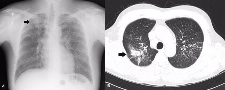 This composite medical image displays a chest radiograph (A) and an axial thin-section computed tomography (CT) scan (B) demonstrating occupational lung disease, specifically silicosis. (A) The posterior-anterior chest X-ray reveals diffuse, bilateral, ill-defined small nodular opacities with a predilection for the upper and middle lung zones. A prominent large opacity is noted in the right upper lobe (black arrow), suggesting Progressive Massive Fibrosis (PMF). (B) The axial CT scan at the level of the upper lobes confirms the presence of diffuse, multiple rounded centrilobular nodules. Significant findings include a large conglomerated mass in the right upper lobe (black arrow) and smaller areas of coalescing nodules in the left upper lobe. These radiological features are characteristic of complicated silicosis, where individual silicotic nodules merge into larger masses of fibrous tissue. The distribution is typically upper-lobe dominant, reflecting the common pattern seen in pneumoconiosis and sarcoidosis.