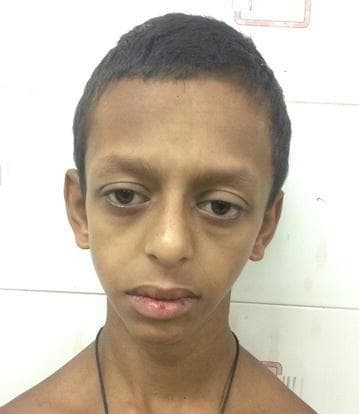 Clinical photograph showing the facial features of a pediatric patient exhibiting 'elfin facies,' a dysmorphic appearance characteristic of Williams syndrome. Key visible features include a broad forehead and prominent, low-set ears. The midface is characterized by a flat nasal bridge with a bulbous nasal tip and periorbital puffiness (soft tissue fullness around the eyes). The mouth shows a long philtrum and a wide, prominent mouth with a relatively thin upper lip. These phenotypic characteristics are associated with a 7q11.23 microdeletion. The image serves as an educational reference for medical genetics and pediatrics to identify the clinical manifestations of this chromosomal disorder, which often correlates with systemic findings such as supravalvular aortic stenosis and hypercalcemia.