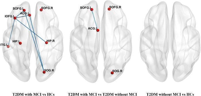 This Comparison Chart illustrates brain network connectivity alterations in patients with Type 2 Diabetes Mellitus (T2DM) and Mild Cognitive Impairment (MCI) using three axial-view brain mapping diagrams. The visualization identifies specific anatomical regions as red nodes and functional or structural connections as blue edges. Panel 1 (T2DM with MCI vs HCs) displays a dense network of eight nodes, including the Left and Right Superior Frontal Gyrus (SOFG), Left Inferior Frontal Gyrus (IOFG), Left Anterior Cingulate Gyrus (ACG), Bilateral Hippocampus (HIP), Left Inferior Temporal Gyrus (ITG), and Right Superior Occipital Gyrus (SOG), indicating significant connectivity differences compared to healthy controls. Panel 2 (T2DM with MCI vs T2DM without MCI) reveals a simpler four-node network with a prominent edge connecting the SOFG.L and ACG.L, highlighting regional alterations associated specifically with cognitive decline in diabetic patients. Panel 3 (T2DM without MCI vs HCs) shows an empty brain template, indicating no significant network differences between these groups. This visualization demonstrates the neuro-pathophysiological progression of T2DM-related cognitive impairment through graph theory analysis.