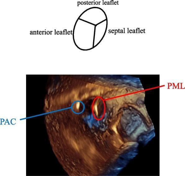 This visual content features a 3-dimensional transesophageal echocardiographic (3D TEE) image of the tricuspid valve, accompanied by a schematic diagram for anatomical orientation. The image shows an 'en face' surgeon’s view of the tricuspid valve from the right atrium perspective. Key anatomical components identified in the schematic and 3D volume include the anterior, posterior, and septal leaflets. Two distinct medical devices are visible passing through the valve orifice: a pacemaker lead (PML), highlighted by a red circle, and a pulmonary artery catheter (PAC), highlighted by a blue circle. The PML is strategically positioned at the septal-posterior (SP) commissure, appearing closely associated with the valve annulus in that region. Conversely, the PAC is located between the anterior-posterior (AP) leaflets. This diagnostic imaging demonstrates the spatial relationship between multiple intracardiac devices and the tricuspid valve anatomy, serving as an educational resource for perioperative monitoring and understanding device-related interference or positioning during cardiac procedures.