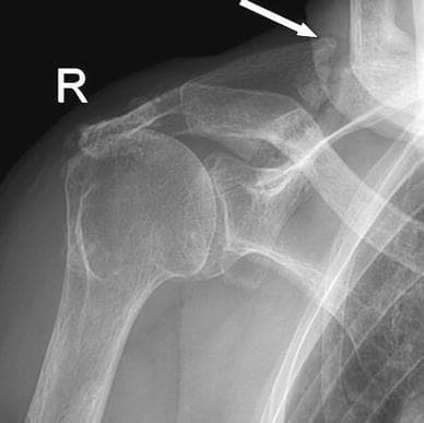 This anteroposterior (AP) X-ray of the right shoulder demonstrates an insufficiency fracture of the scapular spine, indicated by a white arrow. There is visible disruption of the cortical continuity of the scapula with associated periosteal reaction and hazy callus formation around the fracture site, though a clear fracture line remains, signifying a lack of complete bony consolidation. The image reveals generalized osteopenia with thinning of the cortical bone and decreased trabecular density, consistent with the patient's history of osteoporosis and chronic corticosteroid use. Additionally, there is superior migration of the humeral head relative to the glenoid, suggesting a chronic rotator cuff deficiency. The glenohumeral and acromioclavicular joints appear relatively preserved in terms of joint space. This imaging is clinically significant for evaluating non-traumatic or insufficiency fractures in elderly patients presenting with progressive shoulder pain and functional impairment.