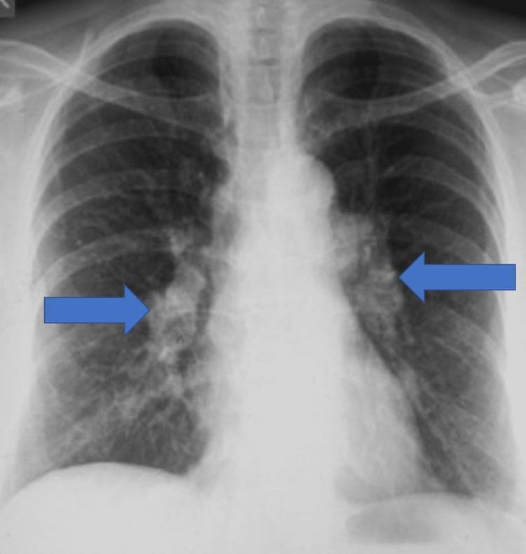 This diagnostic image is a posteroanterior (PA) chest radiograph demonstrating bilateral hilar lymphadenopathy. Two prominent blue arrows indicate symmetrical enlargement of the lymph nodes in the right and left hilar regions. These enlarged nodes appear as lobulated, increased opacities with well-defined lateral borders, typical of the 'potato nodes' appearance often seen in sarcoidosis. The lung parenchyma appears relatively clear with no visible consolidation, nodules, or interstitial thickening. The mediastinal silhouette is intact, although the paratracheal regions should be evaluated for concomitant adenopathy. The cardiac shadow is within normal limits in size and contour, and the costophrenic angles are sharp, indicating no pleural effusion. This radiographic presentation is a classic finding for Stage I sarcoidosis, providing a key diagnostic feature for medical students and clinicians in identifying granulomatous diseases or lymphoma. The clinical significance lies in recognizing the symmetrical distribution, which helps differentiate sarcoidosis from asymmetrical or unilateral causes of hilar enlargement such as malignancy or tuberculosis.