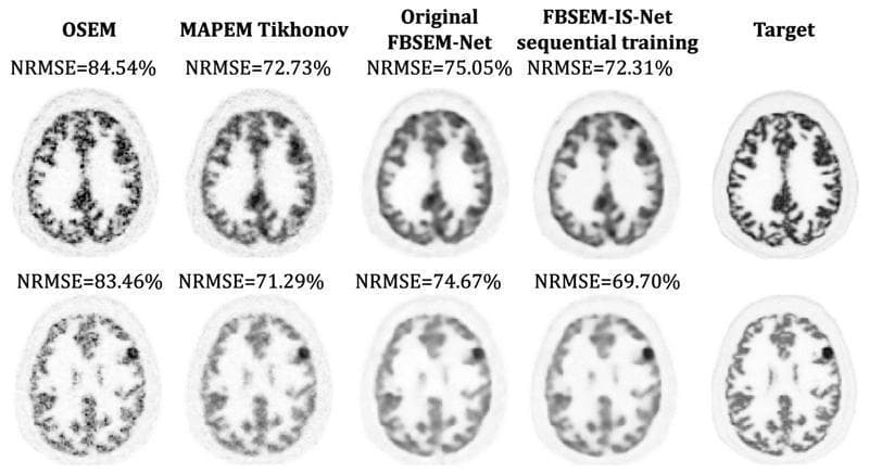 A comparison chart of diagnostic nuclear medicine images demonstrating various PET (Positron Emission Tomography) brain reconstruction algorithms. The image features two rows of axial brain slices, each comparing five methods: OSEM, MAPEM Tikhonov, Original FBSEM-Net, FBSEM-IS-Net sequential training, and a high-count Target reference. The first row displays general brain anatomy, highlighting gray and white matter differentiation. The second row focuses on the reconstruction of simulated circular 'hot lesions' (representing increased radiotracer uptake) within the right cortical region. Quantitative performance is indicated by the Normalized Root Mean Square Error (NRMSE) values above each image. Visually, the OSEM method shows high graininess and noise. MAPEM Tikhonov and Original FBSEM-Net provide moderate smoothing but exhibit some structural blurring. The FBSEM-IS-Net sequential training method demonstrates superior image quality, with the sharpest lesion boundaries, reduced artifacts, and the closest structural resemblance to the Target image. This visual supports research into deep unrolled neural networks for low-count PET image denoising and reconstruction.