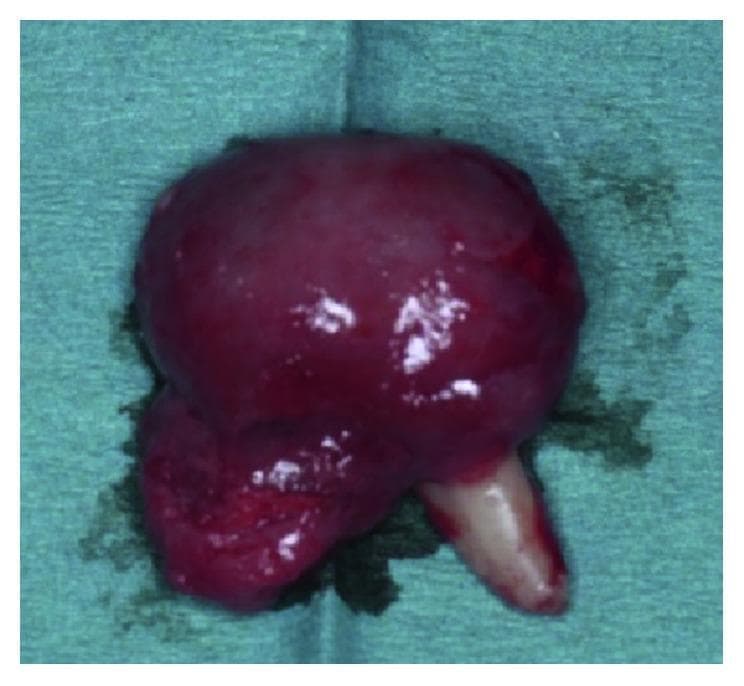 This intraoperative clinical photograph displays an enucleated specimen of an adenomatoid odontogenic tumor (AOT) associated with the maxillary left lateral incisor (tooth #22). The specimen consists of a large, well-encapsulated, bulbous soft tissue mass attached to the mid-root section of the tooth. The mass is approximately 2 cm in size, exhibiting a predominantly deep red to maroon color with a glistening, smooth, and highly vascularized surface. At its inferior aspect, a conical, creamy-white tooth root is visible, extending from the body of the tumor. The interface between the soft tissue and the tooth demonstrates a transition from a smooth capsule to a more irregular, lobulated texture near the point of attachment. This image illustrates the follicular type of AOT, which typically presents as a pericoronal radiolucency mimicking a dentigerous cyst, but is pathologically distinguished by its firm attachment to the tooth root and the characteristic histopathology of spindle-shaped epithelial cells forming whorled masses and duct-like structures.