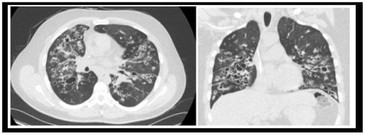 This diagnostic image displays axial (left) and coronal (right) views of a High-Resolution Computed Tomography (HRCT) scan of the chest, focusing on the lung parenchyma. The imaging reveals bilateral, extensive cystic bronchiectasis characterized by severe, permanent dilation of the bronchi, extending to the lung periphery. Visible 'ring-shadow' and 'tram-track' signs are present, indicating thickened bronchial walls. Multiple areas of high-attenuation opacities within the dilated airways suggest mucoid impaction (finger-in-glove sign). The lung parenchyma also exhibits heterogeneous lucencies and cystic changes, characteristic of advanced end-stage lung disease. These findings are clinically significant for the evaluation of severe chronic obstructive and inflammatory processes, such as those found in advanced cystic fibrosis (CF). The image serves as an educational example of progressive bronchiectatic remodeling and mucoid plugging requiring potential surgical intervention like lung transplantation.