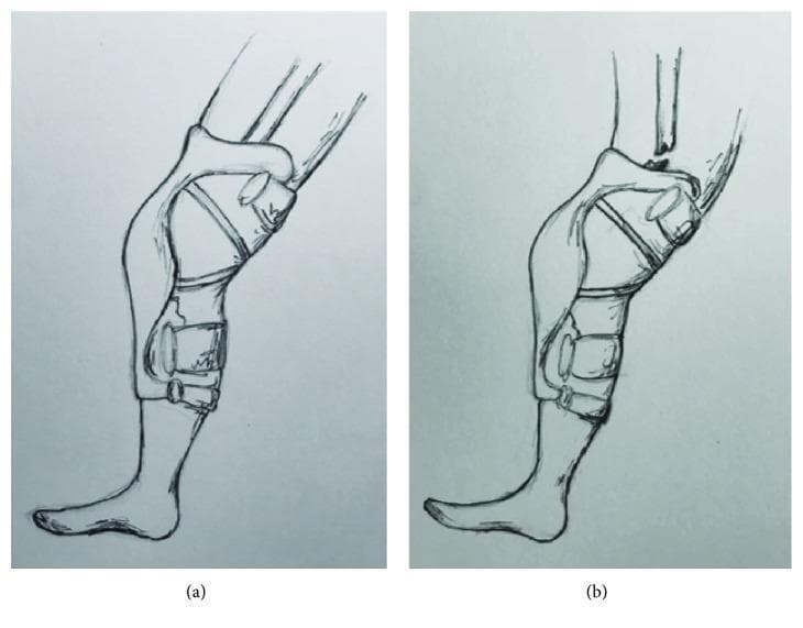 This medical illustration depicts the proposed mechanism of injury for a femoral shaft fracture associated with a rigid knee brace. Panel (a) shows a lower extremity wearing a hard-shell, hinged knee brace in terminal extension. The brace is secured with proximal thigh and distal tibial straps, stabilizing the knee joint. As an extension moment is applied, the rigid proximal edge of the brace acts as a fulcrum against the femur. Panel (b) illustrates the resultant pathology: as hyperextension force exceeds the bone's structural integrity, a transverse fracture occurs in the femoral shaft at the proximal edge of the brace. This diagram highlights the 'stress riser' effect where rigid orthotic equipment can unintentionally transfer forces to adjacent long bones, leading to a cantilever bending injury similar to a 'boot top fracture.' The illustration is intended for orthopedic education, specifically regarding trauma mechanisms in sports medicine and the biomechanical risks of prophylactic bracing in high-impact activities.