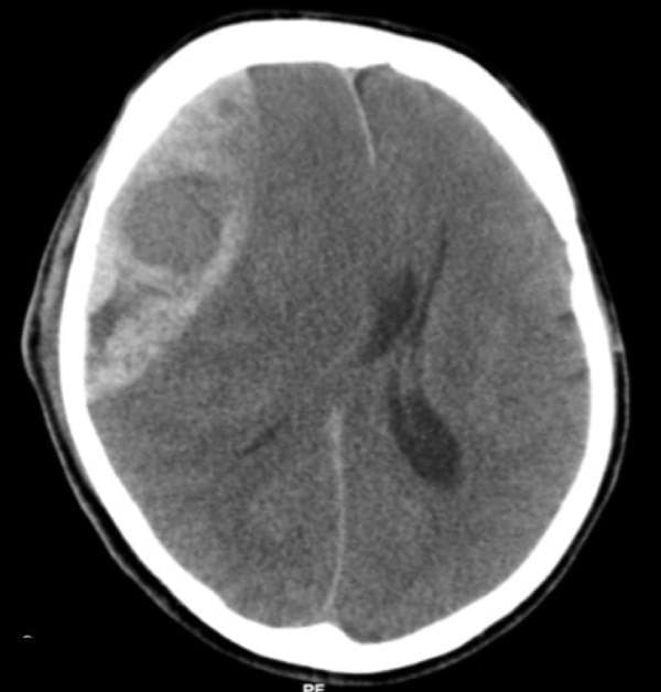 This diagnostic image is an axial non-contrast Computed Tomography (CT) scan of the brain, demonstrating a large, acute epidural (extradural) hematoma. The lesion is located on the right side of the skull and exhibits a classic biconvex or lens-shaped (lentiform) morphology, characterized by a hyperdense appearance relative to the brain parenchyma. The hematoma is clearly demarcated and constrained by the cranial sutures, positioned between the inner table of the skull and the dura mater. The image illustrates a significant mass effect, resulting in the effacement of adjacent sulci, partial compression of the right lateral ventricle, and a notable leftward midline shift of the falx cerebri. These findings are highly characteristic of an acute arterial bleed, typically involving the middle meningeal artery. This scan serves as a critical educational tool for identifying neurosurgical emergencies, understanding intracranial pressure dynamics, and recognizing the radiological hallmarks that differentiate epidural hematomas from crescent-shaped subdural hematomas.