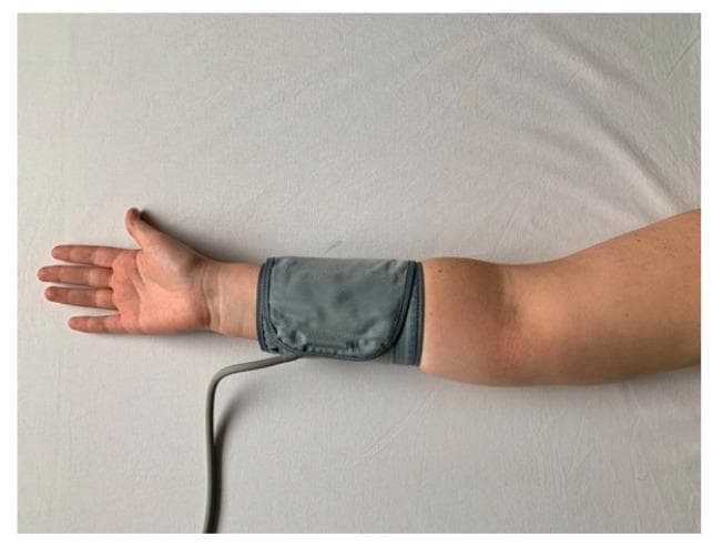 This clinical photograph demonstrates the distal placement of an inflatable blood pressure cuff on a human left forearm. The subject's arm is extended and supinated, with the palm facing upward. The gray fabric sphygmomanometer cuff is positioned distal to the antecubital fossa and proximal to the wrist. A flexible gray inflation tube is visible, extending from the distal margin of the cuff. This specific procedural setup is used in clinical research and vascular physiology to assess flow-mediated dilation (FMD). Distal cuff occlusion is a standardized technique intended to induce reactive hyperemia and investigate nitric oxide-dependent endothelial function in the brachial artery, contrasting with proximal occlusion models that may involve different vasoactive mechanisms. The skin surface is intact with no visible lesions, and the surrounding environment is a neutral white textile background, consistent with a controlled clinical or laboratory setting.