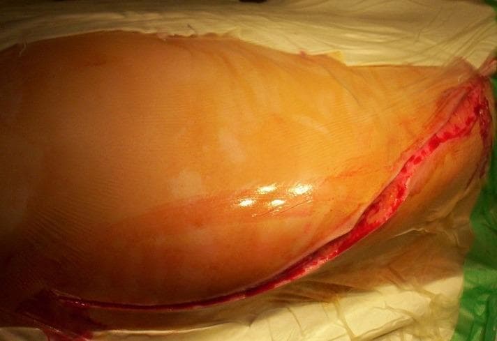 A clinical photograph of a fresh intraoperative surgical site on the posterolateral hemithorax. The image demonstrates a long, oblique incision approximately starting 2 cm lateral to the spinous process and extending inferiorly and laterally toward the midpoint of the XIIth rib. The incision edges are sharp and exhibit minor active bleeding from the dermal and subcutaneous layers. The surrounding skin is prepped for surgery, covered by a clear adhesive surgical drape (incise drape), showing a slightly reflective surface. This visual illustrates a standard posterolateral thoracotomy or retroperitoneal approach, commonly utilized in thoracic or urological surgeries. The anatomical landmarks and orientation are critical for understanding surgical access to the thoracic cavity or kidney.