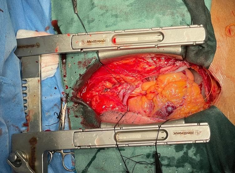 An intraoperative clinical photograph showing a median sternotomy field during Coronary Artery Bypass Graft (CABG) surgery. The thoracic cavity is held open by a metallic Medtronic sternal retractor. Centrally, the human heart is visible, covered partially by epicardial adipose tissue (yellowish in appearance). The primary focus is the ascending aorta, where two saphenous vein grafts have been successfully anastomosed. These proximal anastomoses are secured with fine black sutures visible at the connection points between the tubular vein conduits and the aortic wall. The surgical field includes green and blue sterile drapes, surgical sponges, and several black stay sutures used for tissue retraction. The red, well-perfused myocardium and surrounding tissues indicate active circulation, consistent with the post-cross-clamp phase of the procedure. This image serves as an educational reference for cardiac surgical anatomy, proximal anastomosis techniques in revascularization, and the use of sternal retraction in open-heart surgery.