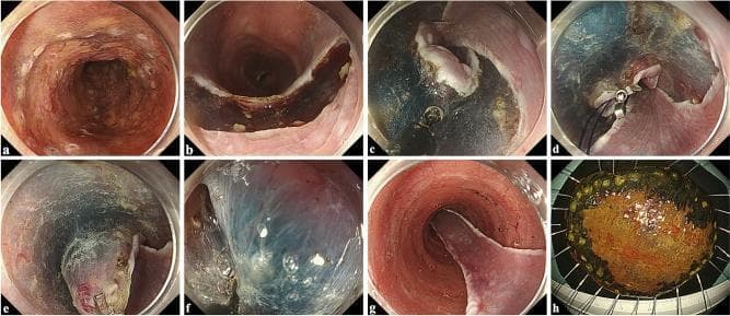 This eight-panel clinical image sequence illustrates a traction-assisted Endoscopic Submucosal Dissection (ESD) procedure for large esophageal cancer. (a) Displays Lugol's iodine chromoendoscopy revealing an unstained neoplastic area with circumferential marking dots. (b) Shows the initial distal (anal) mucosal incision. (c) Demonstrates the completion of circumferential mucosal incisions with trimming of the submucosal edges. (d-f) Illustrate the traction phase, where a metallic clip-with-line is anchored to the oral mucosal edge; pulling the thread provides counter-traction, enhancing visualization of the blue-stained submucosal plane for precise dissection. (g) Visualizes the post-resection esophageal ulcer bed showing clear muscularis propria. (h) Presents the final en bloc resected specimen after ex vivo iodine staining, highlighting the irregular tumor margins for pathological assessment. The sequence serves as a gastrointestinal endoscopy educational resource for advanced therapeutic techniques in managing early-stage esophageal squamous cell carcinoma.