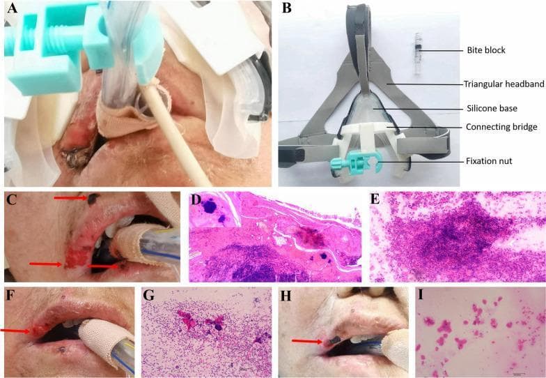 A composite medical figure illustrating a novel mask endotracheal tube (ETT) fixation device and its clinical impact on pressure injuries. (A) Clinical photograph of the device in situ on a patient, showing the integration of the mask-style base with the orotracheal tube. (B) Labeled structural diagram identifying the device components: a gray triangular headband, a clear silicone base, a white resin connecting bridge, a blue fixation nut for tube security, and a transparent bite block. (C, F, H) Serial clinical photographs showing the progression of lip pressure injuries. (C) Baseline shows severe erythema, ulceration, and crusting (indicated by red arrows). (F) Day 3 shows moderate resolution of the ruptured regions. (H) Day 5 demonstrates significant healing of the vermilion border and reduced lesion size. (D, E, G, I) Histopathological and cytopathological panels. (D) H&E stain of baseline tissue showing epidermal fractures and bacterial colonies (inset). (E, G, I) Tissue-print cytology progression from dense inflammatory exudate and necrosis (E) to significant reduction in inflammatory cells and debris by Day 5 (I).