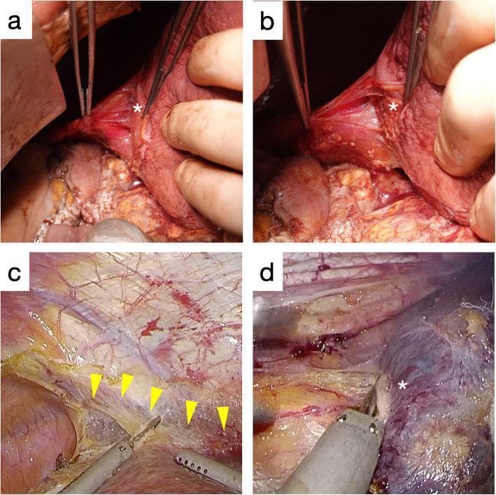 This composite figure presents clinical photographs and intraoperative images comparing dissection layers of the liver's bare area. Panels (a) and (b) show cadaveric anatomy; (a) demonstrates the liver surface (*) covered in dense, glossy white connective tissue when dissected at the outer layer of the fused peritoneum (near the diaphragm), while (b) reveals a 'naked' or exposed liver parenchyma (*) when dissected at the inner layer (near the liver). Panels (c) and (d) provide intraoperative laparoscopic views. Panel (c) highlights the transitional line between the outer and inner peritoneal layers (yellow arrowheads) during a partial hepatectomy for hepatocellular carcinoma. Panel (d) shows the exposure of the liver surface (*) covered only by thin connective tissue during dissection of the inner layer for colorectal liver metastasis. These images illustrate the surgical importance of recognizing the multilayered structure of the fused peritoneum to ensure appropriate oncological margins and safe dissection planes during laparoscopic hepatic surgery.